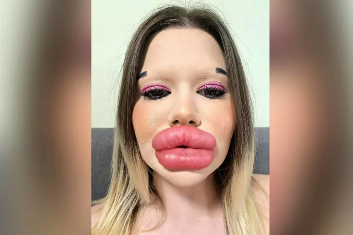 Diese Frau möchte die größten Lippen der Welt haben! Ärzte warnen